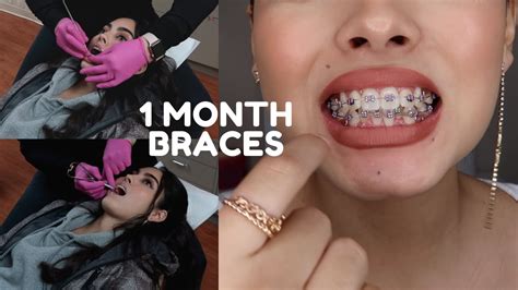1 month braces transformation|My ONE MONTH Braces Update & Transformation .